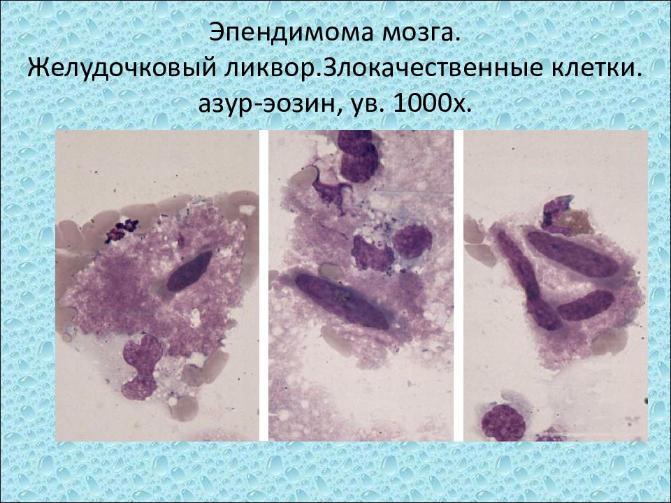 Исследование ликвора презентация