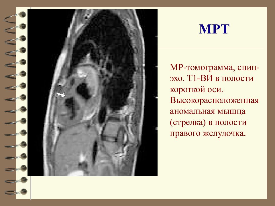 Эхо полости. Спин Эхо мрт.