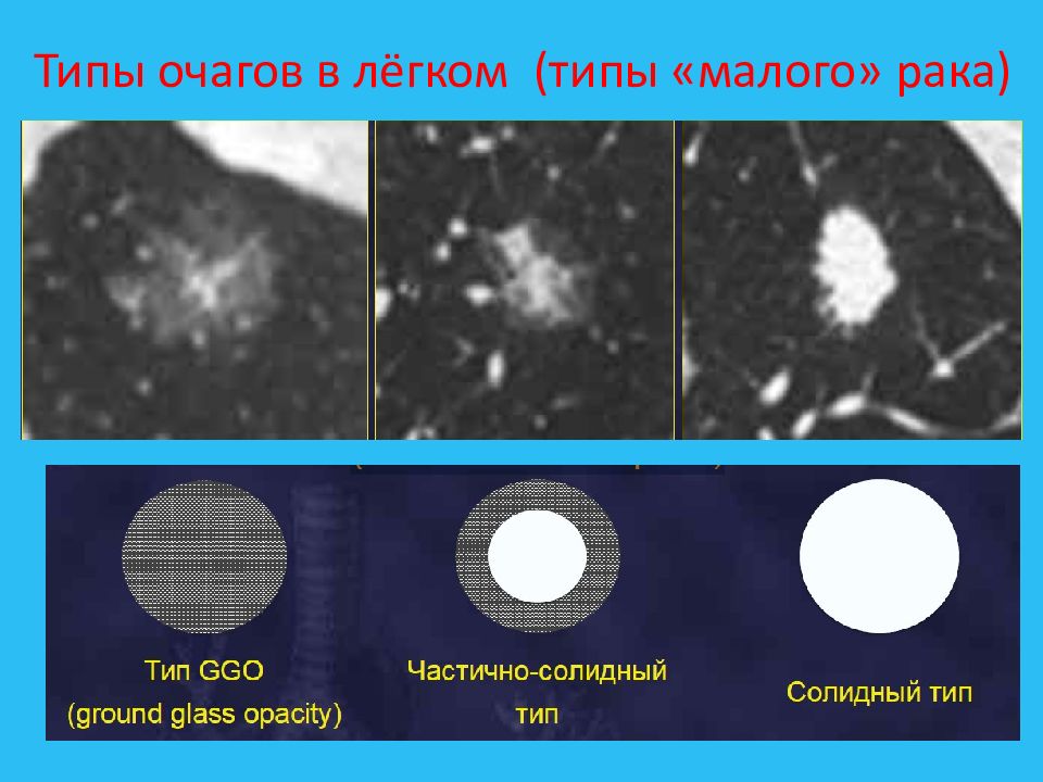 Что значит солидные очаги. Солидный очаг в легком. Солидный очаг в легком на кт. Классификация очагов в легких.