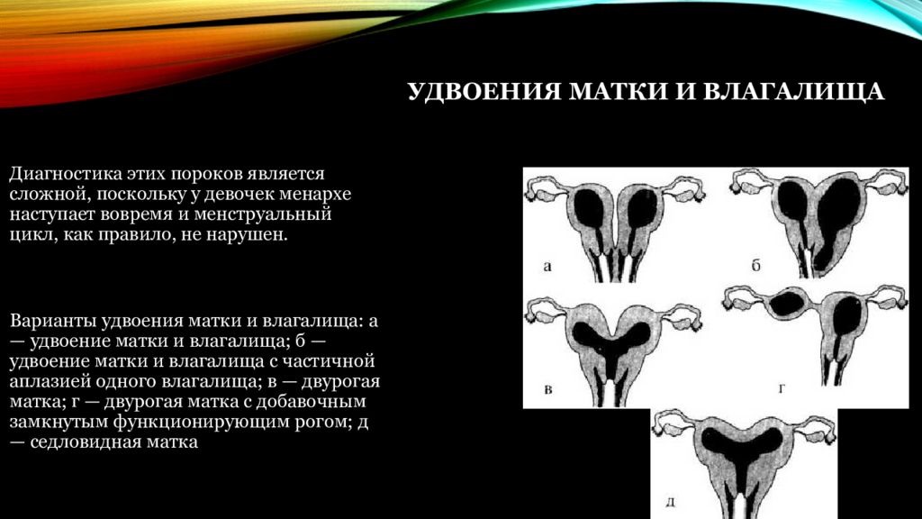 Аномалии Влагалища Фото