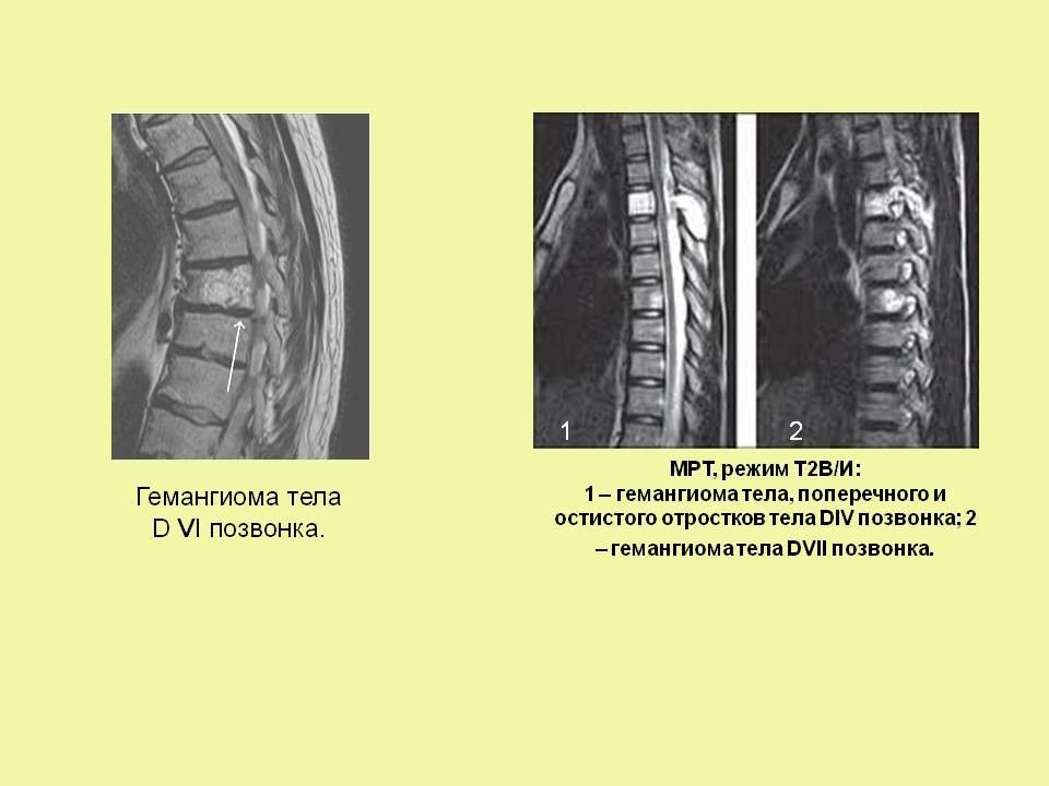 Гемангиома th12 позвонка что