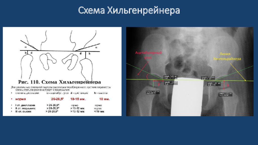 Ацетабулярный угол у детей