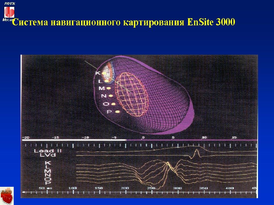 Аритмии и блокады сердца презентация