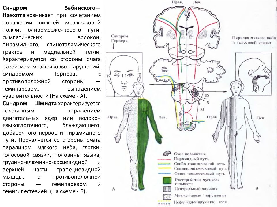 Альтернирующие синдромы схема