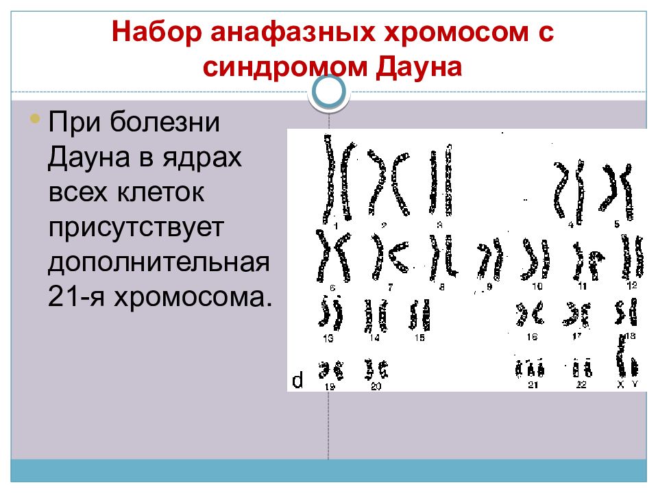 Сколько хромосом у дауна. Синдром Дауна хромосомы. Набор хромосом. Синдром Дауна хромосомный набор. Набор хромосом у Дауна.