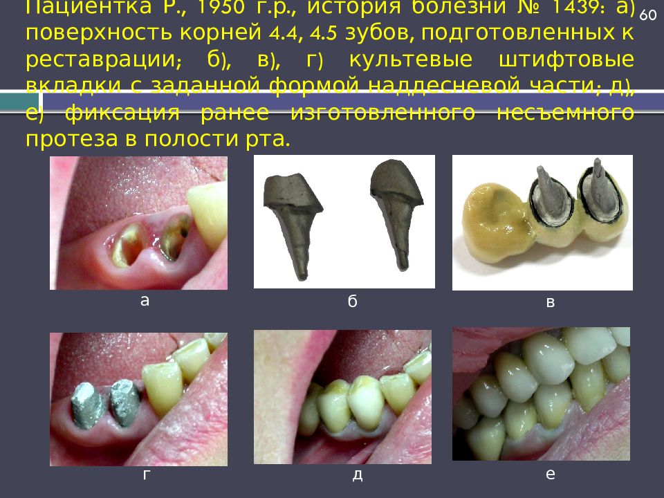 Пациентка Р., 1950 г.р., история болезни № 1439: а) поверхность корней 4.4, 4.5 зубов, подготовленных к реставрации; б), в), г) культевые штифтовые вкладки с