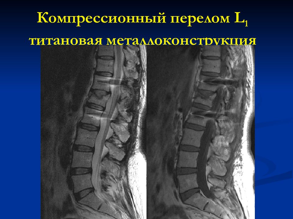 Компрессионный перелом степени. Компрессионный перелом. Компрессионный перелом позвоночника. Компрессионный перелом кт. Компрессионный перелом мкб.