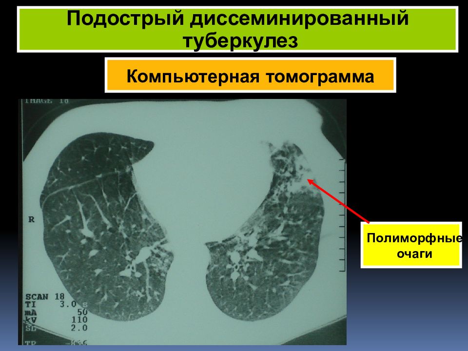 Диссеминирующий процесс в легких. Подострый диссеминированный туберкулез кт. Диссеминированный туберкулез легких кт описание. Инфильтративный туберкулез на кт. Диссеминированный туберкулез легких кт.