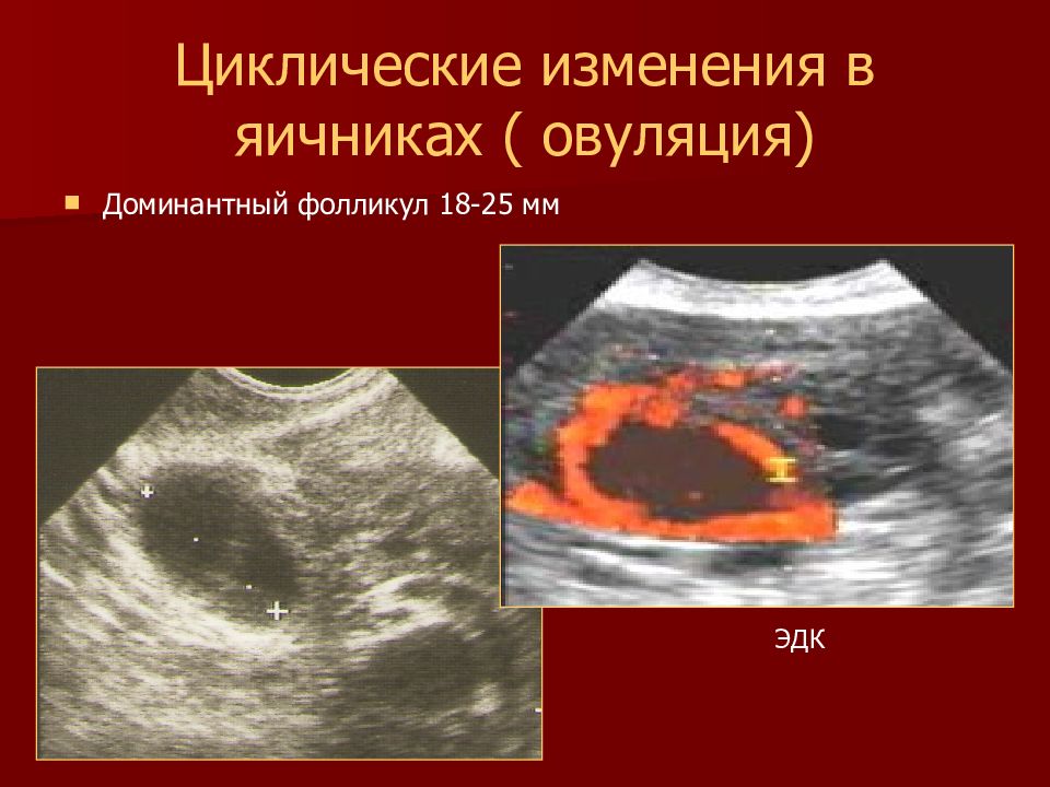 Доминантный фолликул в правом яичнике что это. Доминантный фолликул в яичнике. Персистенция доминантного фолликула. Циклические изменения в яичнике.