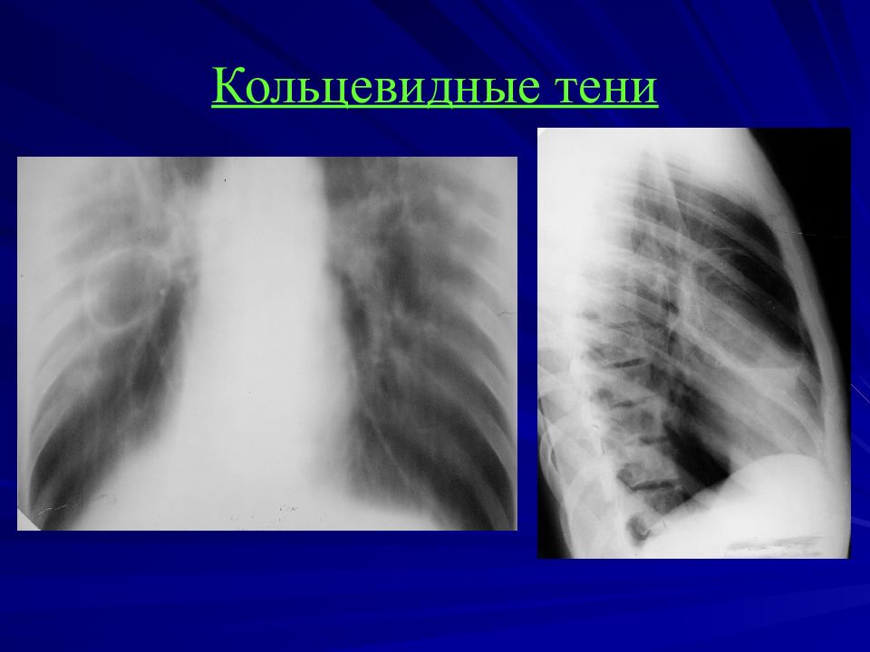 Тень в легких. Синдром кольцевидной тени рентген. Кольцевидная тень туберкулема. Туберкулезная каверна кольцевидная тень. Синдром круглой тени патологии легочной ткани.