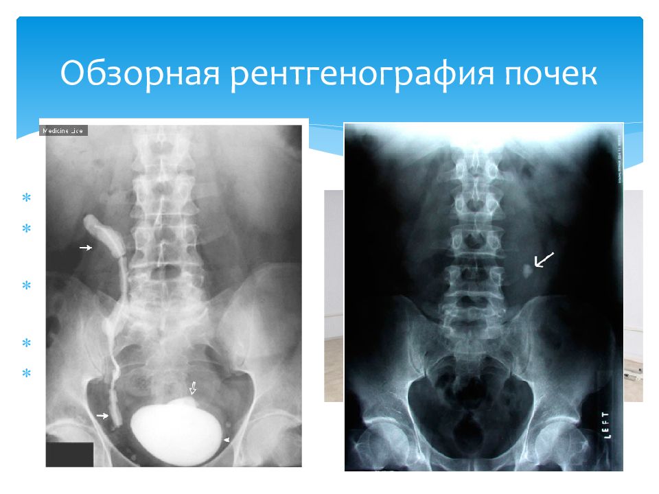 Лучевая диагностика мочевыделительной системы презентация