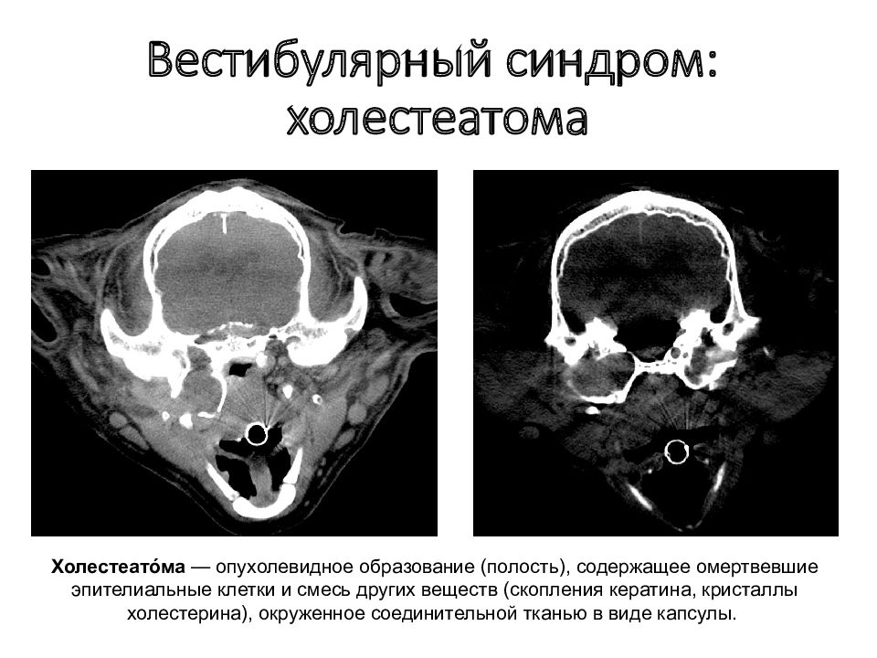 Холестеатома кт картина