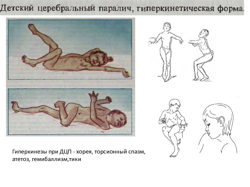 Дцп презентация неврология