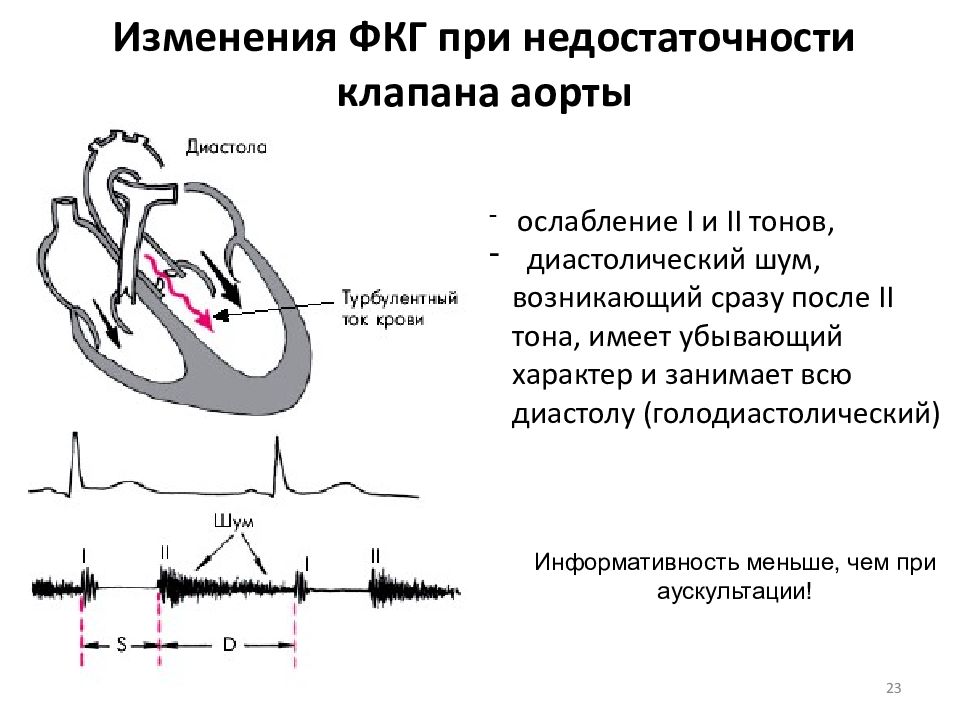 Аортальная недостаточность картинки