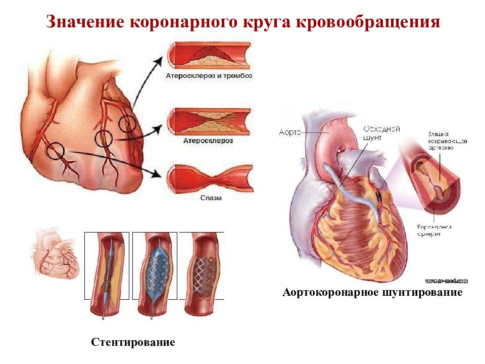 Презентация коронарное шунтирование