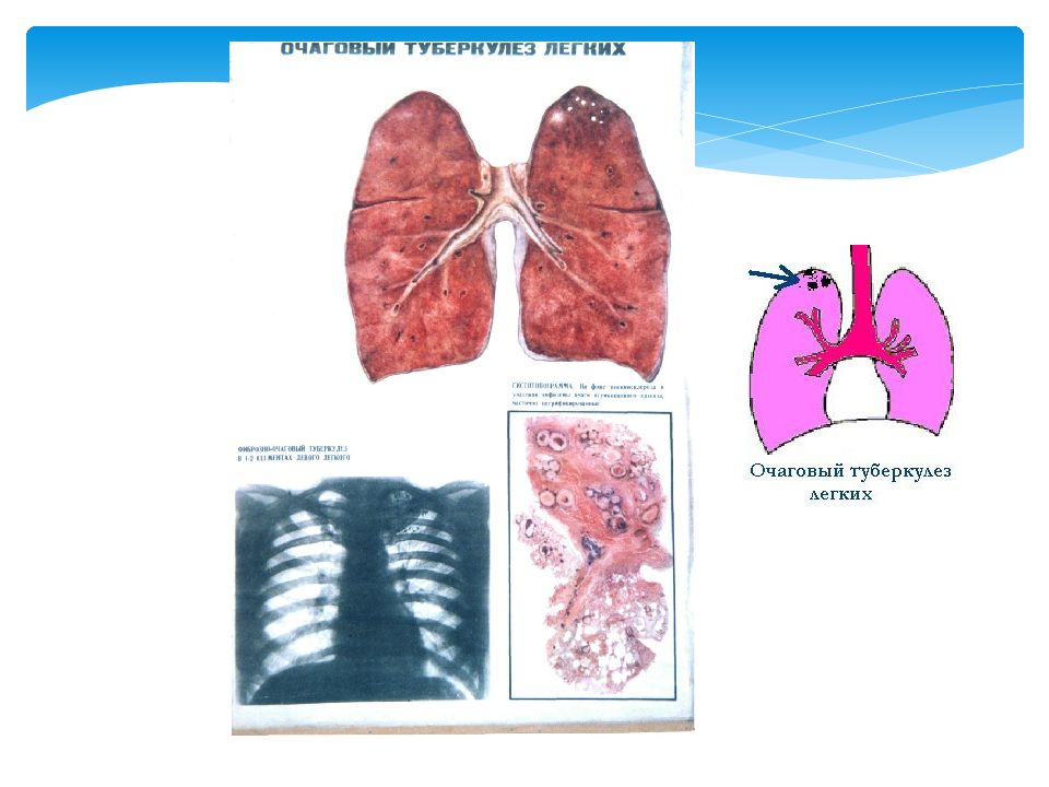 Очаговый туберкулез. Острый очаговый туберкулез легкого. Очаговый туберкулез верхушки левого легкого схема. Легкие при туберкулезе очаговом.