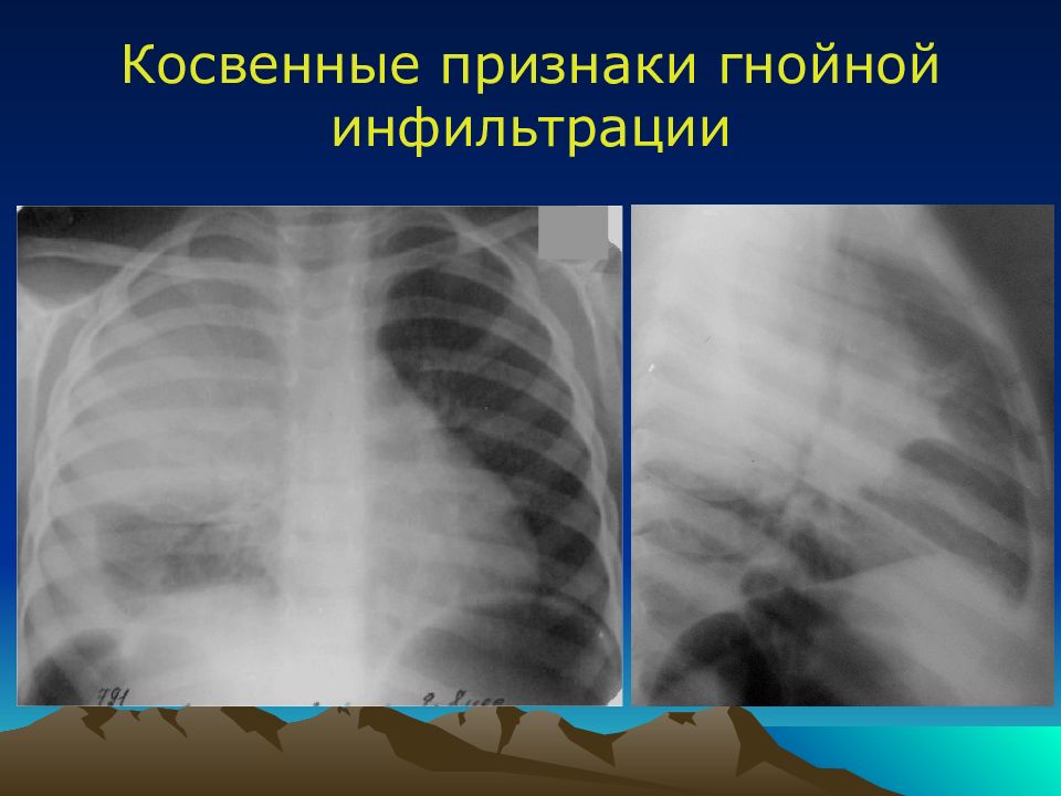 Острая гнойная деструктивная пневмония у детей презентация