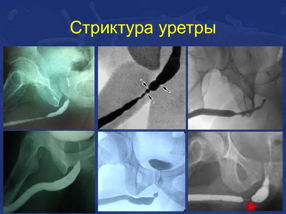 Травмы уретры презентация