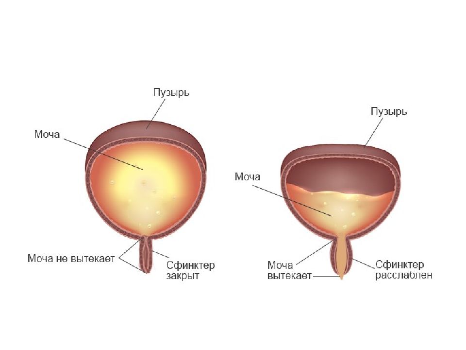 Откуда моча. Гипоактивный мочевой пузырь. Неадаптированный мочевой пузырь. Нейрогенная слабость мочевого пузыря. Нейрогенная дисфункция мочевого пузыря.