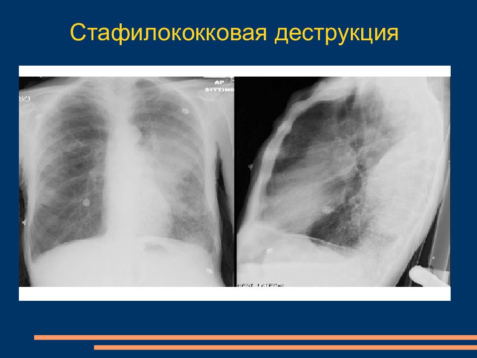 Бактериальная деструкция легких у детей презентация