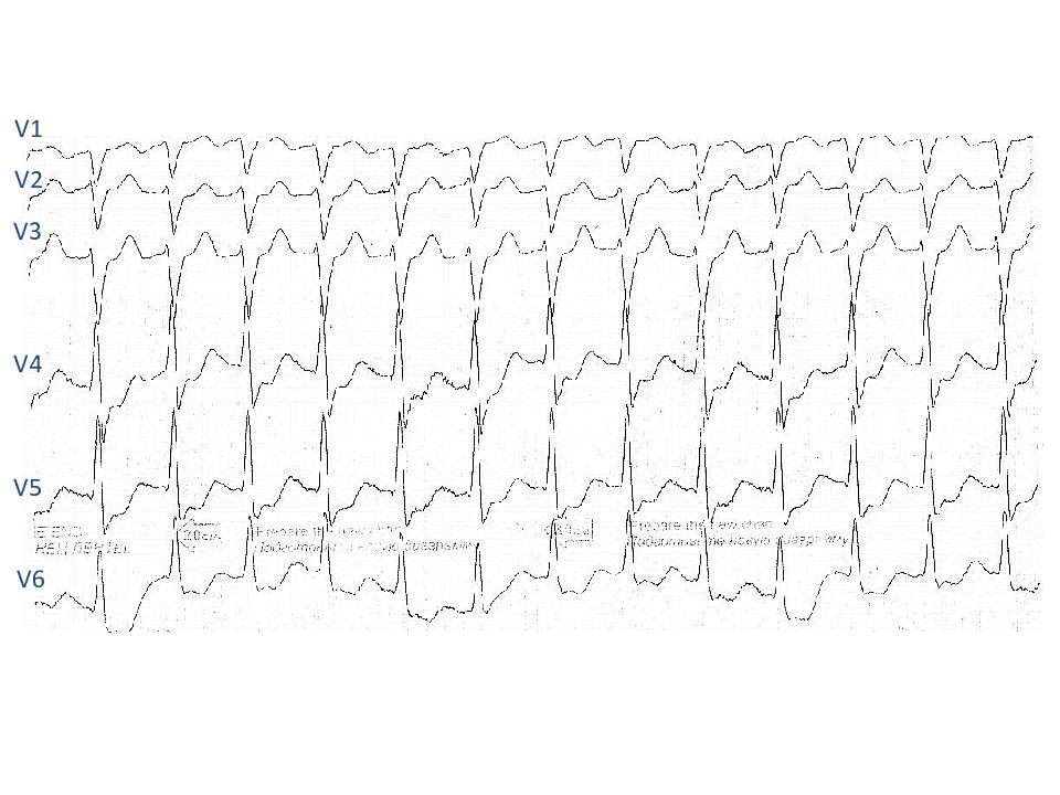 Экг v1 v6. Поверхностное многополюсное ЭКГ-картирование.. V1 v2 v3 на ЭКГ. Электроды ЭКГ схема наложения.