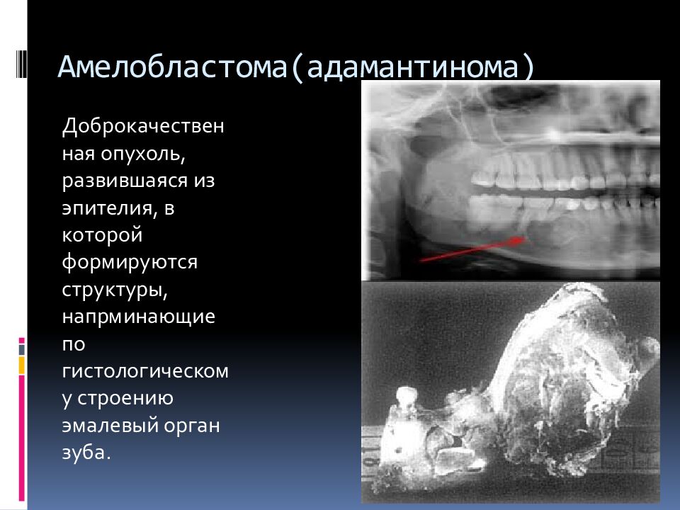 Амелобластома ( адамантинома )