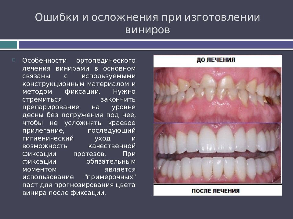 Ошибки и осложнения при изготовлении виниров