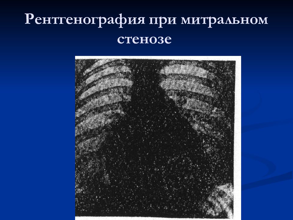 Рентгенологическая картина при митральном стенозе