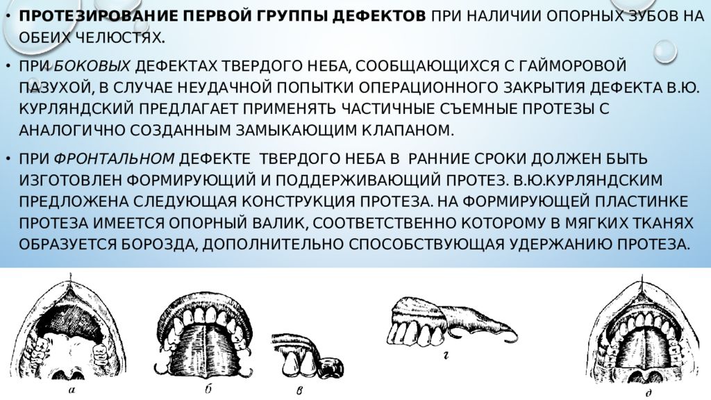 Группы дефектов. Дефекты твердого неба по Курляндскому. Протезирование дефектов верхней челюсти. Дефекты неба классификация.