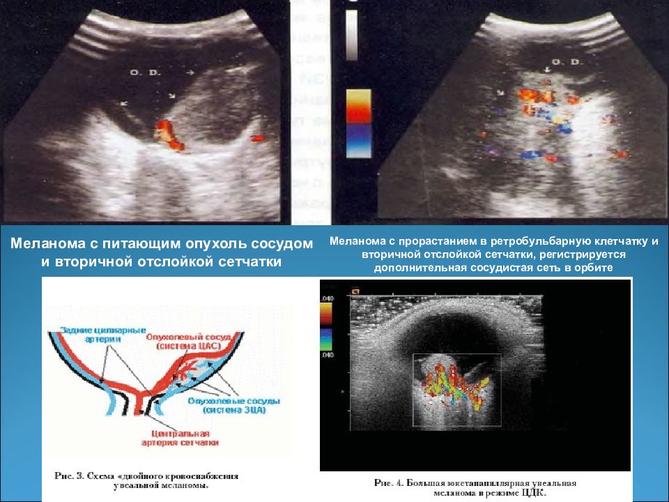 Мрт меланомы. ЦДК меланомы хориоидеи. Меланома хориоидеи УЗИ. Меланома ультразвуковая диагностика.