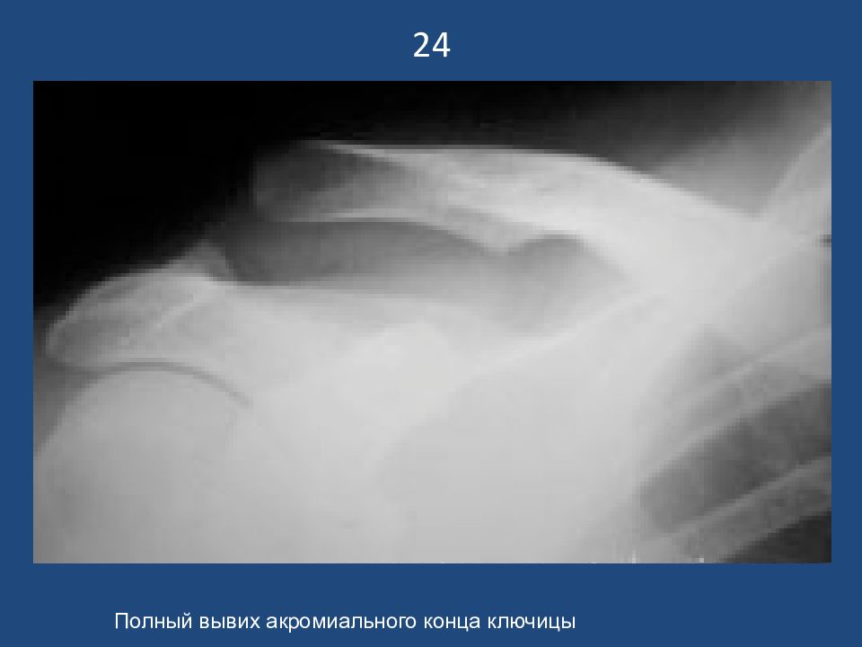 24 Полный вывих акромиального конца ключицы