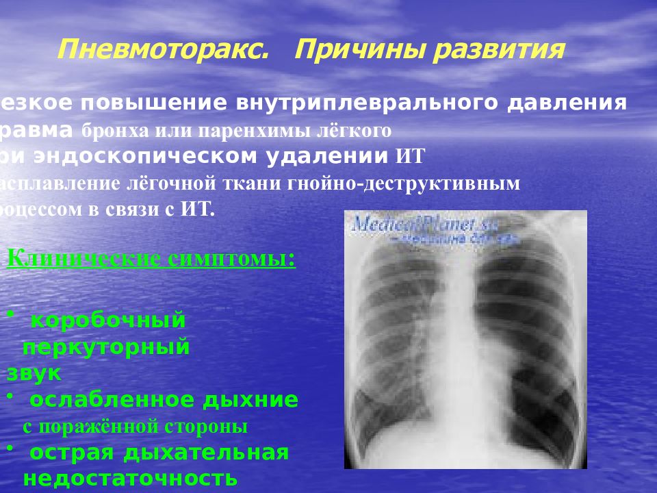 Пневмоторакс легких. Причины развития пневмоторакса. Пневмоторакс причины возникновения.