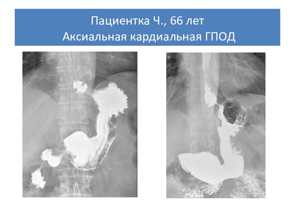 Аксиальная грыжа пищеводного отверстия диафрагмы. Скользящая грыжа пищеводного отверстия диафрагмы рентген. Аксиальная грыжа пищеводного отверстия диафрагмы рентген. Скользящая кардиальная грыжа пищеводного отверстия рентген. Аксиальная кардиальная.