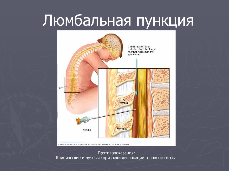 Люмбальная пункция презентация