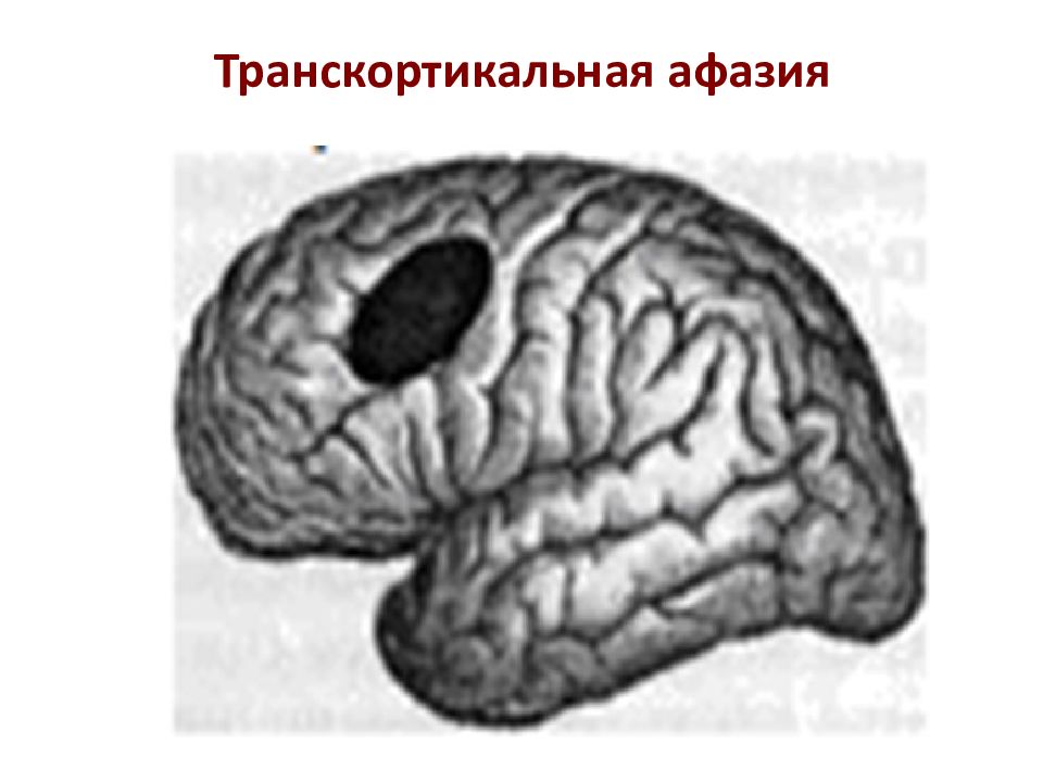 Проблемы афазий. Транскортикальная сенсорная афазия. Транскортикальная моторная афазия. Травматическая афазия Лурия. Моторная афазия у левшей.