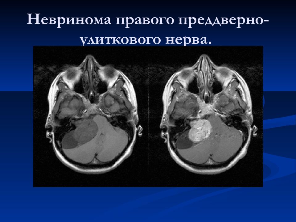 Невринома что это такое. Оливопонтоцеребеллярная атрофия мрт. Невринома слухового нерва кт. Невринома мостомозжечкового угла на кт. Мультисистемная атрофия головного мозга на мрт.