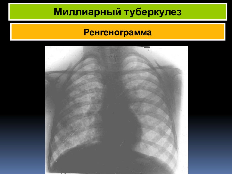 Пульмонология фтизиатрия. Миллиарный и диссеминированный туберкулёз. Миллиарный туберкулёз фото.. Симптом «перстня» на ренгенограмме характерен для. Симптом «перстня» на ренгенограмме характерен д.