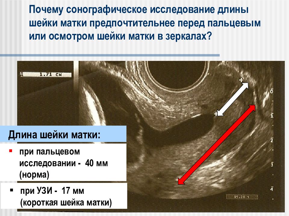 Почему 65. Короткая шейка матки при беременности УЗИ. УЗИ беременность шейка норма. Шейка матки при беременности по неделям.