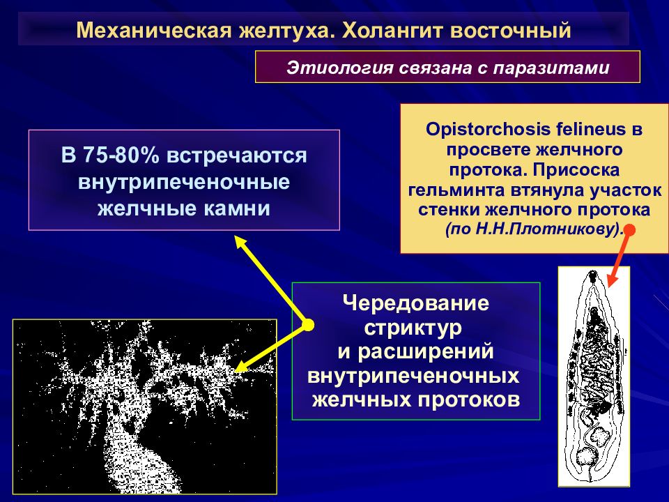 Уплотнение внутрипеченочных протоков. Холангит. Холангит при механической желтухе. Внутрипеченочная холангиоэктазия.