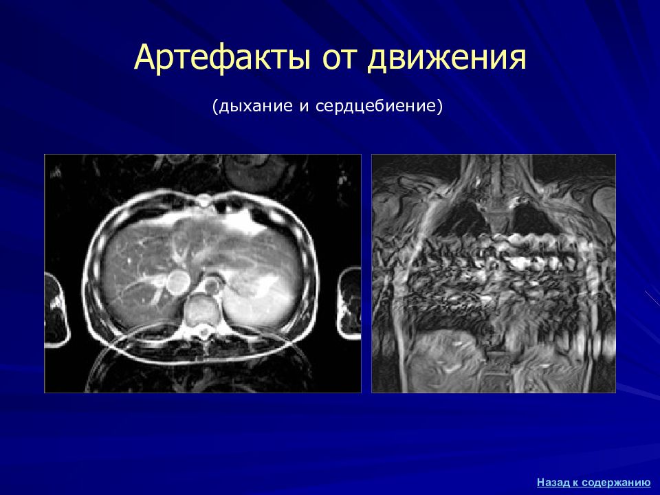 Артефакты мрт презентация