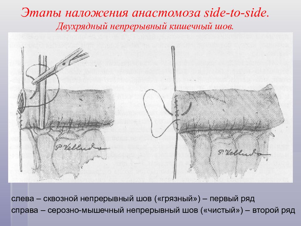 Кишечный шов презентация