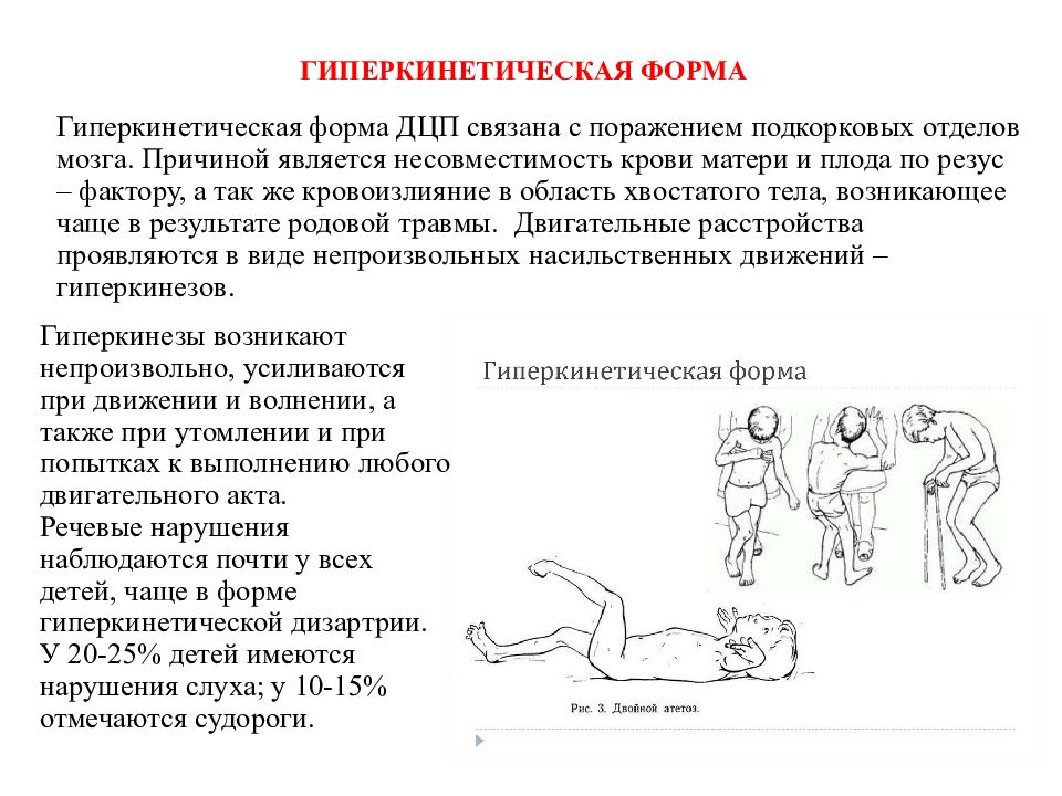 Дцп гиперкинетическая форма презентация