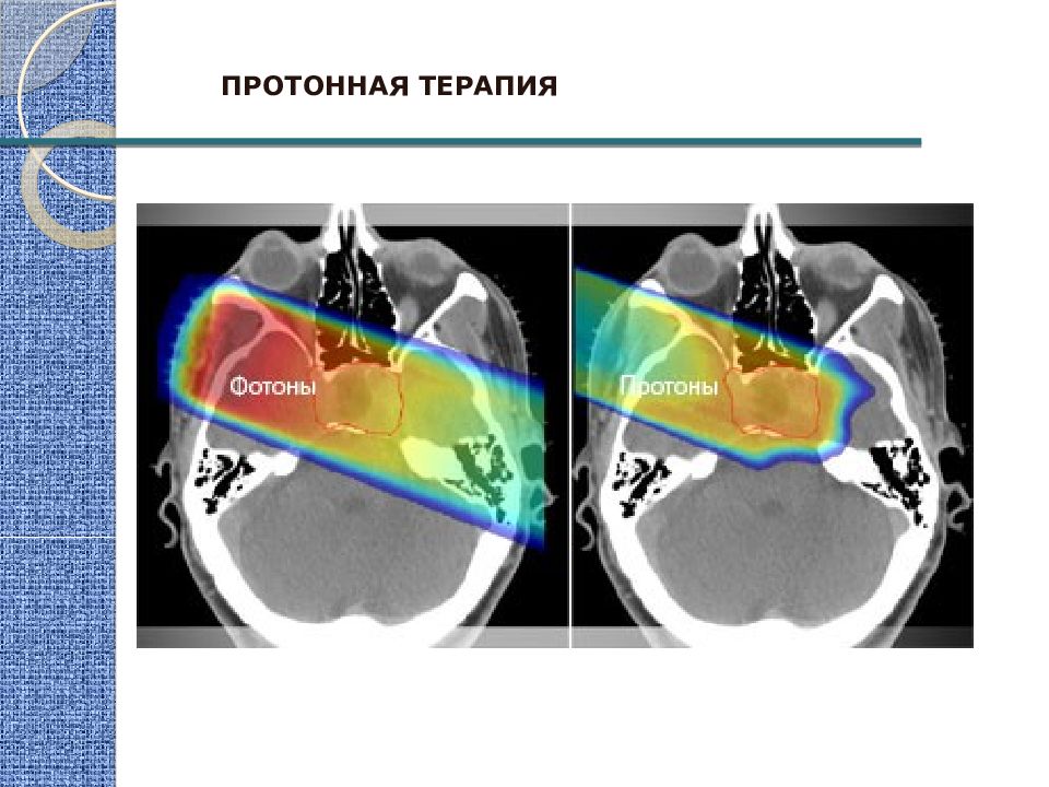 Протонная терапия. Протонная лучевая терапия. Протонная лучевая терапия презентация. Протонный нож в онкологии.