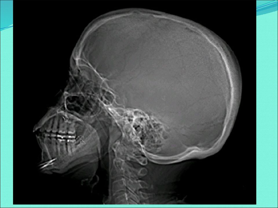 Снимок головы. Рентгеновские снимки мозга. Рентген головы без мозга.