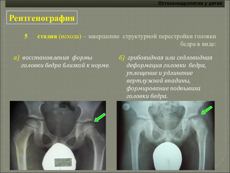 Головка бедренной. Деформация вертлужной впадины рентген. Остеохондропатия Пертеса. Асептический некроз вертлужной впадины тазобедренного сустава. Остеохондропатия тазобедренного сустава.