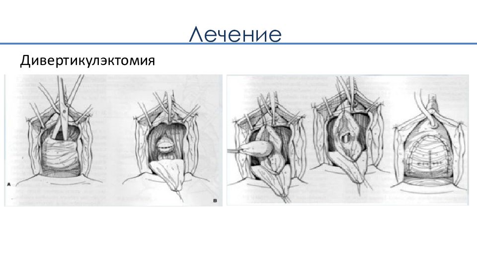 Парауретральная железа у женщин