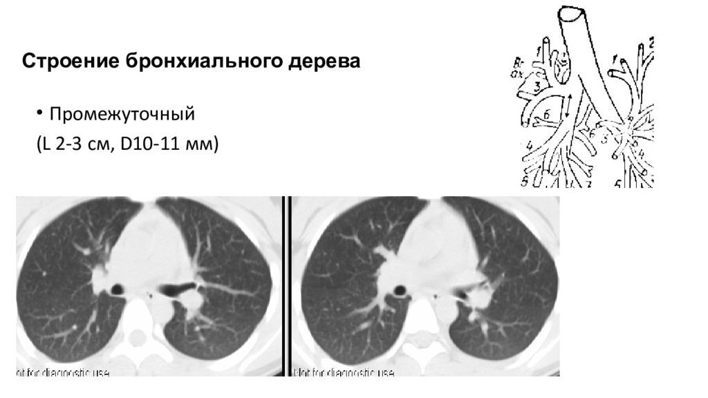 Кт бронхов. Анатомия бронхиального дерева на кт. Бронхи анатомия кт. Бронхи сегменты кт. Строение бронхиального дерева кт.