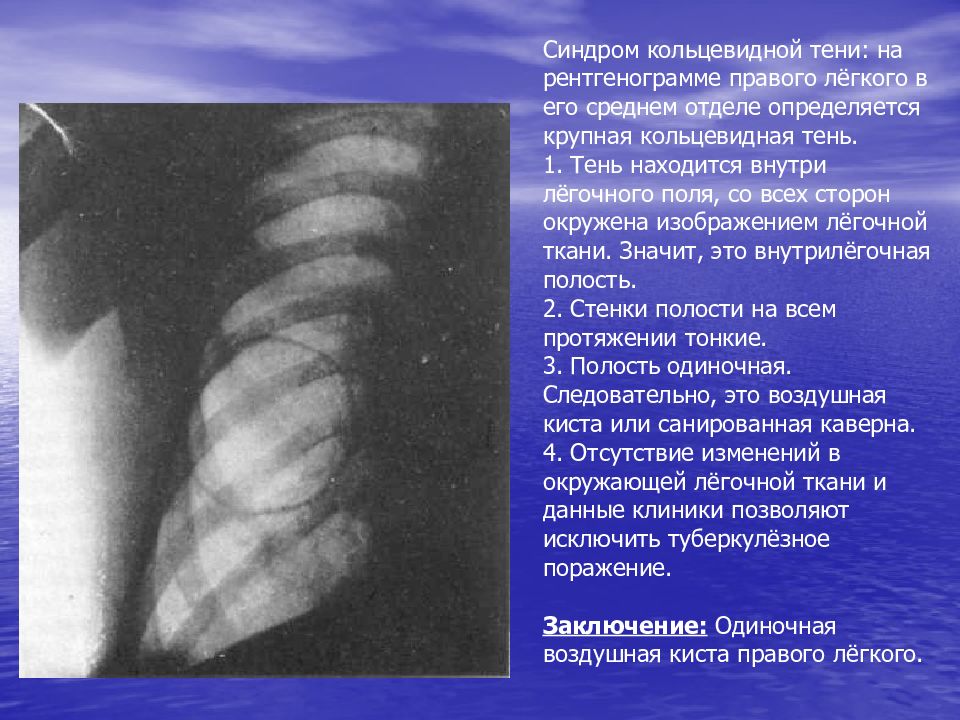 Рентгенологические синдромы легких. Кольцевидная тень туберкулема. Синдром кольцевой тени. Рентгенологический синдром кольцевидной тени. Синдром кольцевидной тени на рентгенограмме легких.