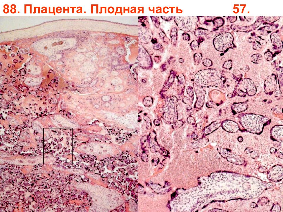 Плацента гистология. Фибриноид плаценты гистология. Плацента гистология препарат. Материнская часть плаценты гистология препарат.