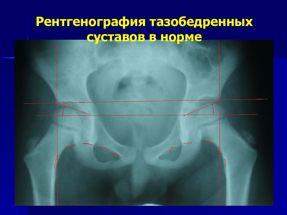 Подготовка к рентгену тазобедренного сустава — что можно …